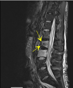 Vertebral Compression Fracture