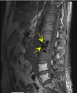 Vertebral Compression Fracture