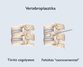 Vertebroplasty